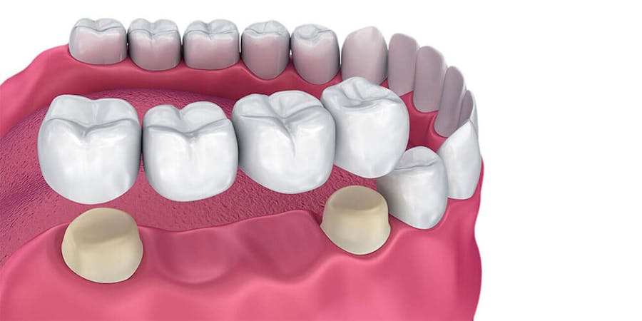 Dental Bridges Milton
