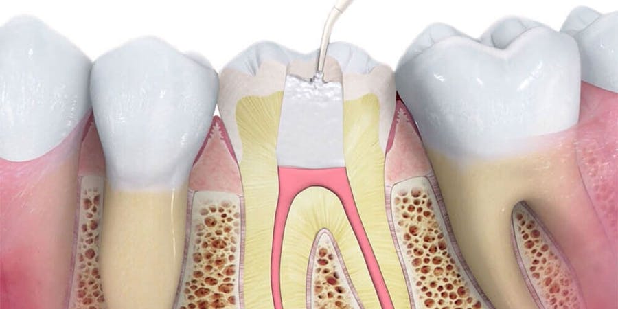 Root Canal Treatment Milton